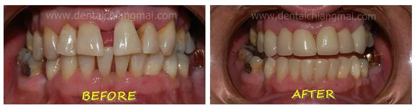 Dental Veneers by Dental Chiang Mai patient 3