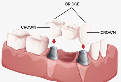 Dental Bridge Chiang Mai, Thailand Dental Bridge Chiang Mai, Thailand