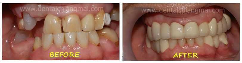 Dental Crowns by Dental Chiang Mai