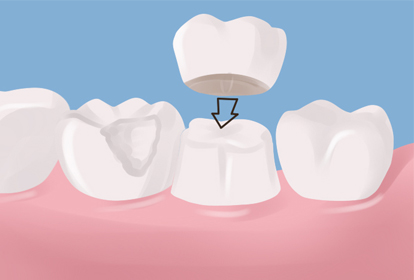 Dental Crown By Dental Chiang Mai, Thailand