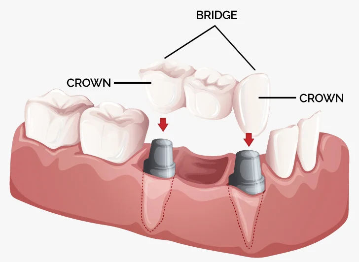 dental bridges chiangmai