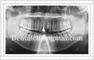 Implant Clinical Case 1