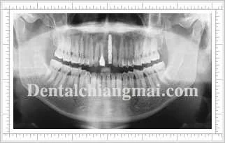 Implant Clinical Case 1