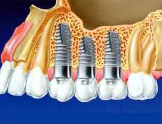 Dental Implant Chiang Mai, Thailand