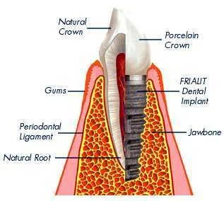 Dental Implant Chiang Mai