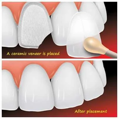 Dental Veneers by Dental Chiang Mai