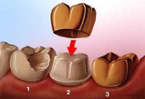 Dental Crowns by Dental Chiang Mai