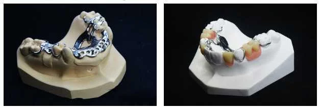 Dental Denture by Dental Chiang Mai