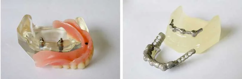 Denture Attachment by Dental Chiang Mai