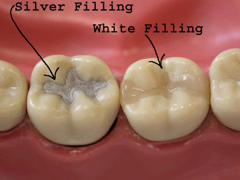 Dental Fillings by Dental Chiang Mai