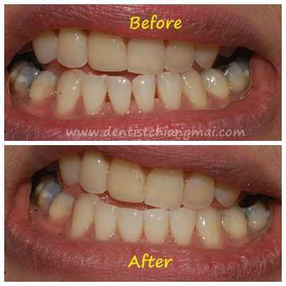 Filling Teeth Gap by Dental Chiang Mai