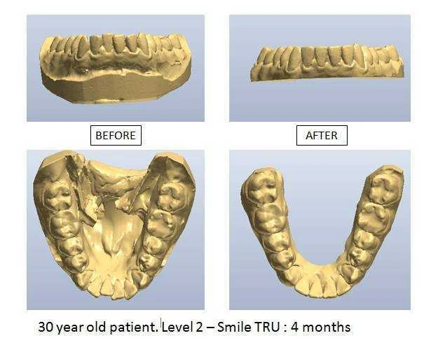 Smile TRU Invisible Orthodontics. At Dental Clinic in Chiang Mai, Thailand.
