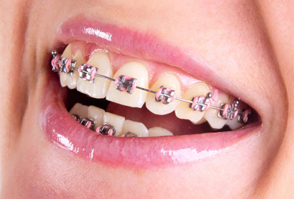 Orthodontics Treatment