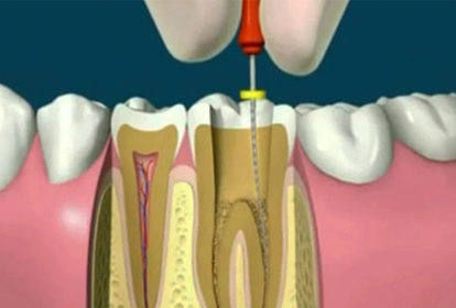 Root Canal Treatment Dental Chiang Mai