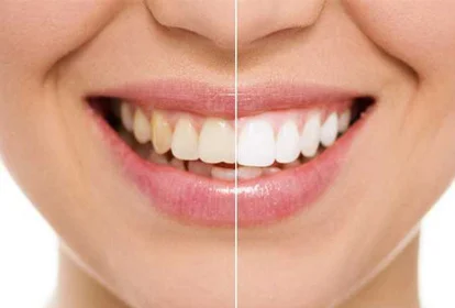 Teeth Whitening Dental Chiang Mai, Thailand